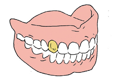 ⑤金の入れ歯